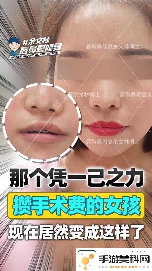 呵护兔唇宝宝的微笑需要多少颗温暖的爱心-手术背后藏着的无私力量